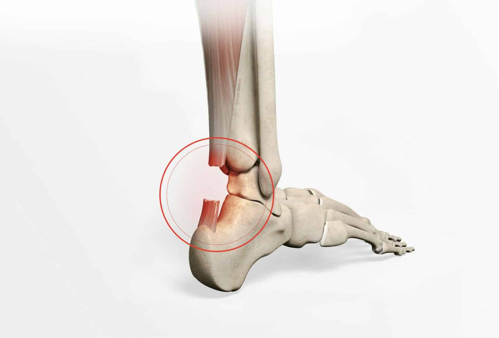 Peignage du tendon d’achille - Chirurgie par dr Paillard à Paris