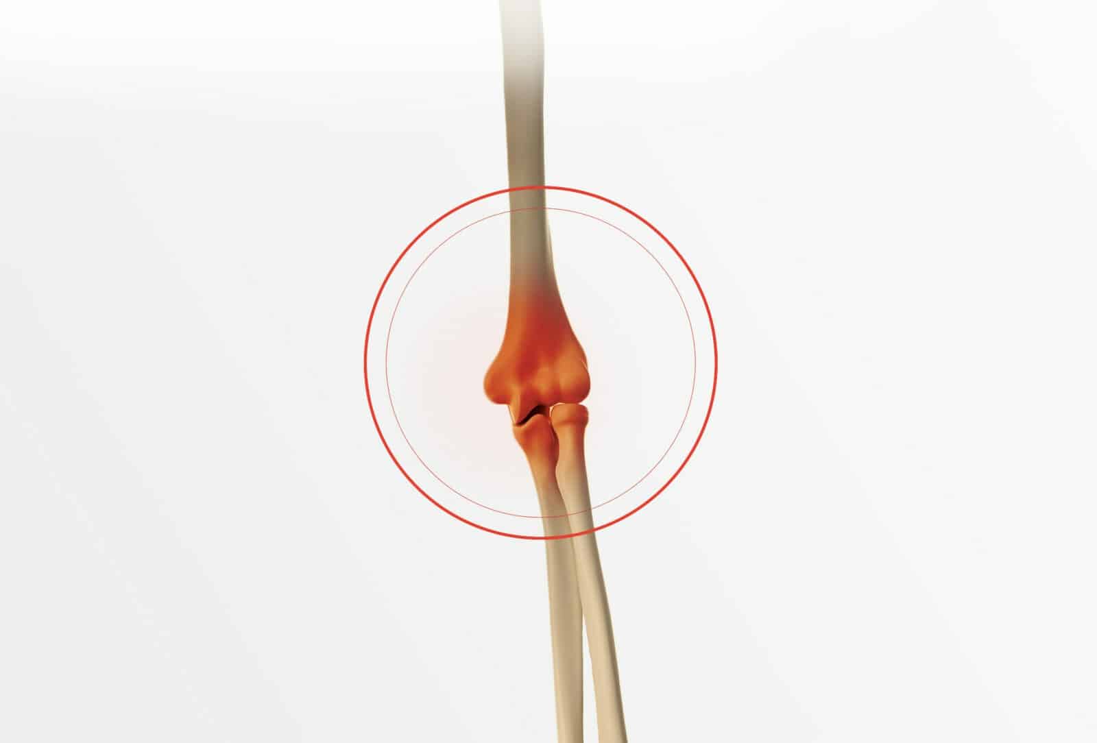 Chirurgie du coude à Paris: Prothèse de la tête radiale - Dr Paillard, Chirurgien orthopédique