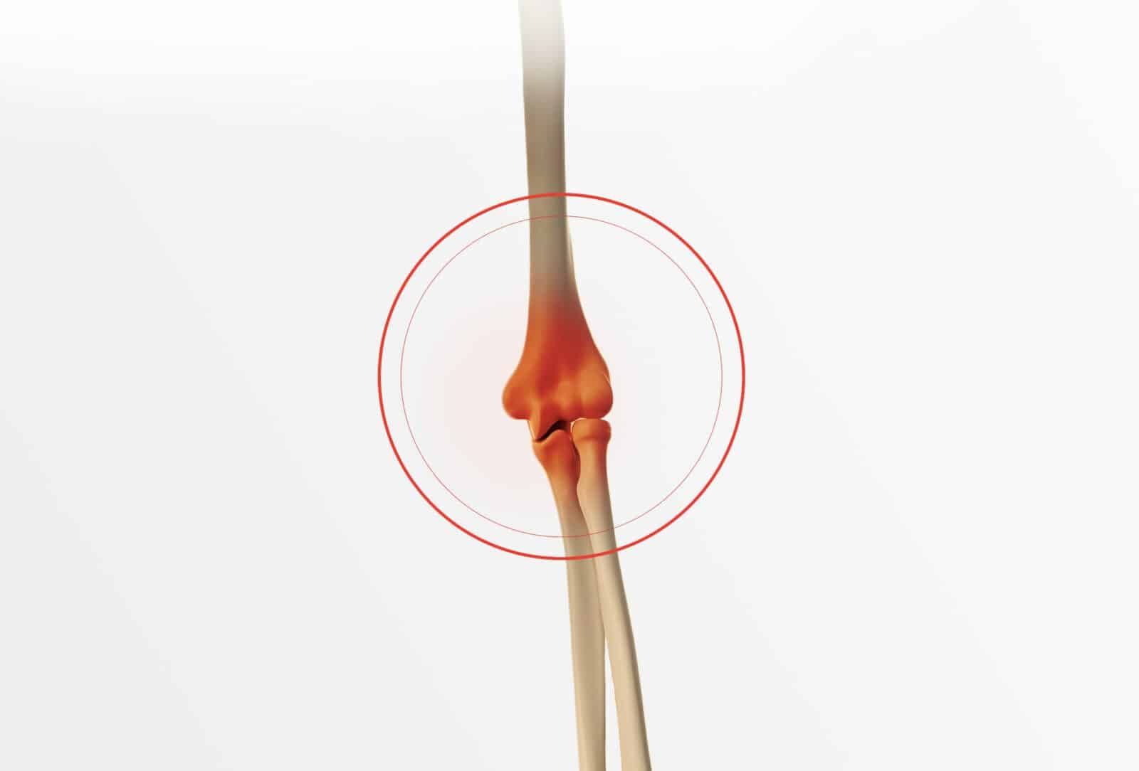Chirurgie du coude à Paris: Prothèse tête radiale pour remplacer l’articulation du coude - dr Paillard