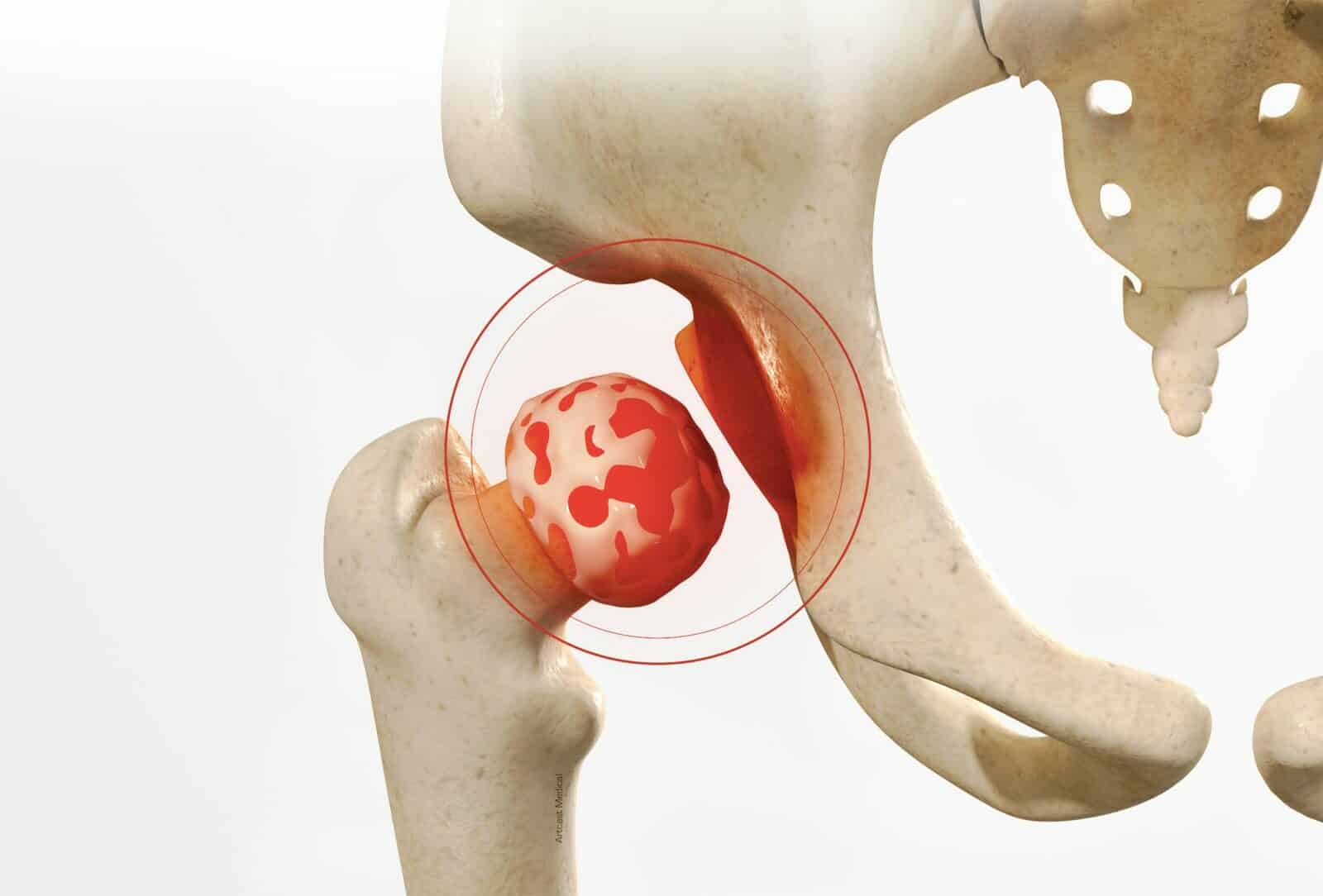 Prothèse totale de la hanche - dr Paillard à Paris Chirurgien orthopédique à Paris