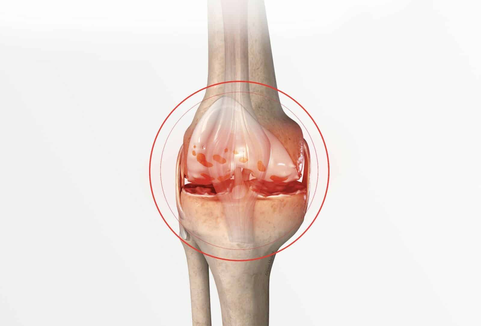 Chirurgie du genou à Paris: Prothèse unicompartimentale du genou - Dr Paillard