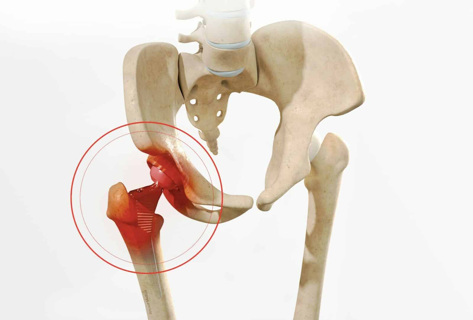 Chirurgie de la hanche à Paris: Reprise de prothèse de hanche - dr Paillard