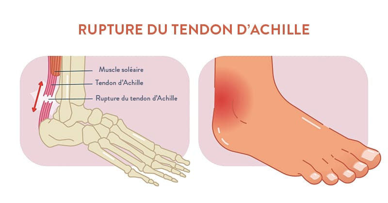 Les blessures fréquentes au pied causées par le sport et leur traitement -  L'Équipe