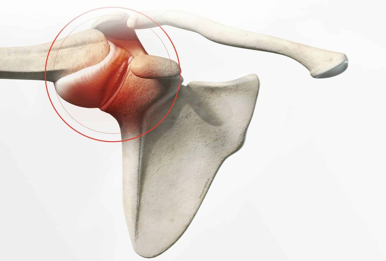 Chirurgie de l’épaule (Stabilisation de l’épaule) à Paris par Docteur Paillard
