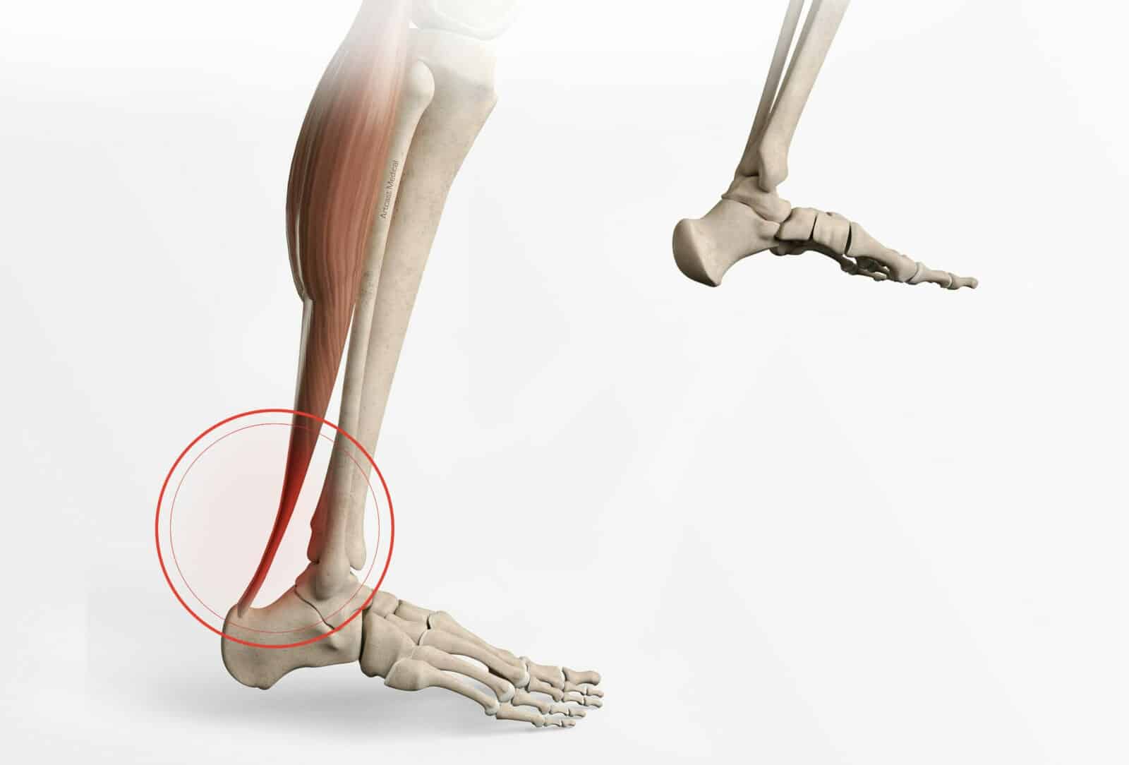 Stabilisation fibulaire - Chirurgie par dr Paillard à Paris