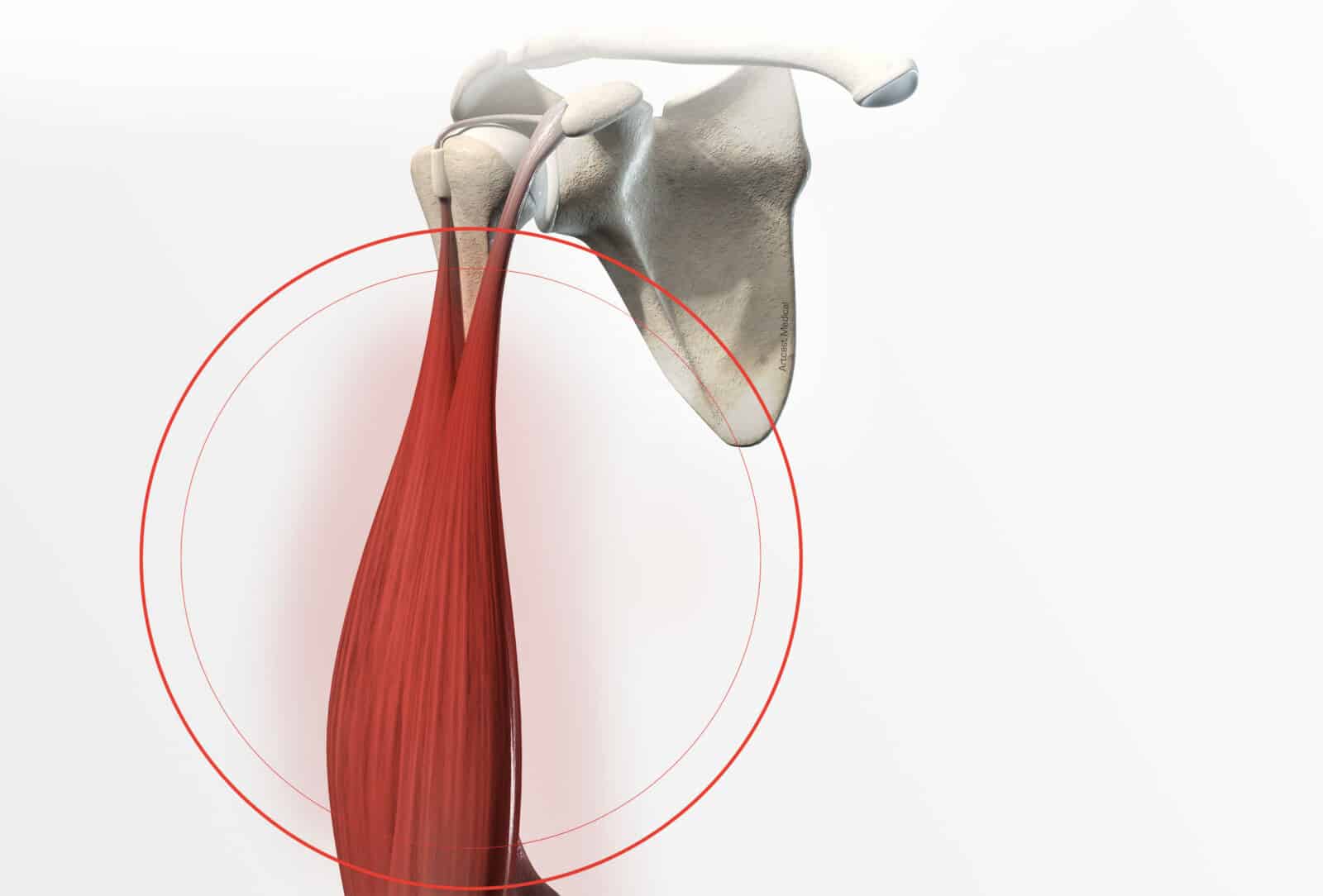 Tendinite du long biceps/ tendinite du biceps brachial: Diagnostic et traitement à Paris