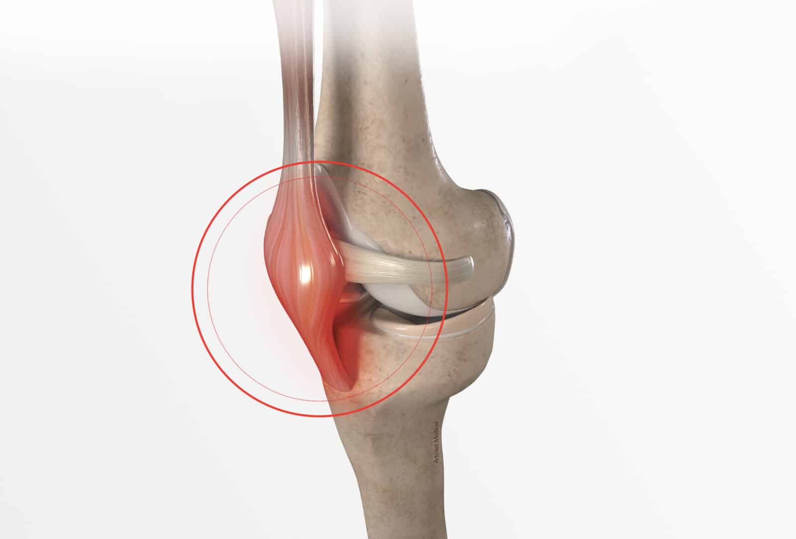 Symptômes et diagnostic de la tendinite du talon rotulien