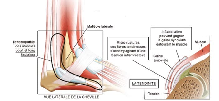 Symptômes et diagnostic de la tendininopathie des fibulaires | Dr ...