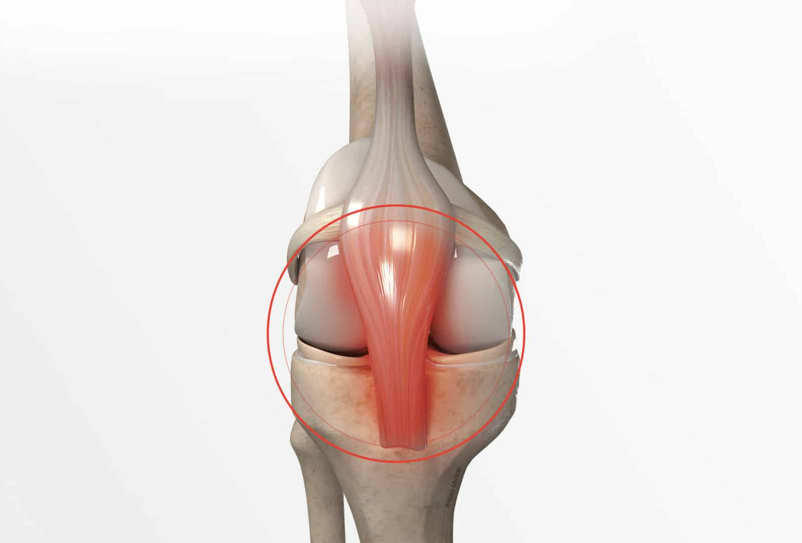 Chirurgie du genou à Paris: Traitement de la rupture du tendon rotulien et du tendon quadricipital