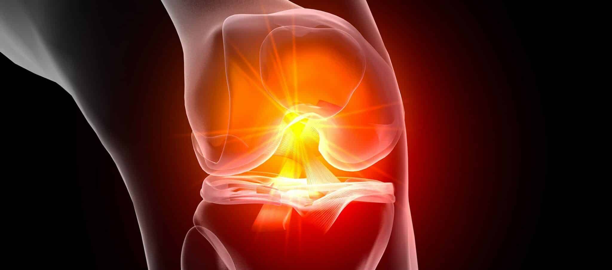 Rupture partielle du ligament croisé antérieur, traitements | Dr Paillard