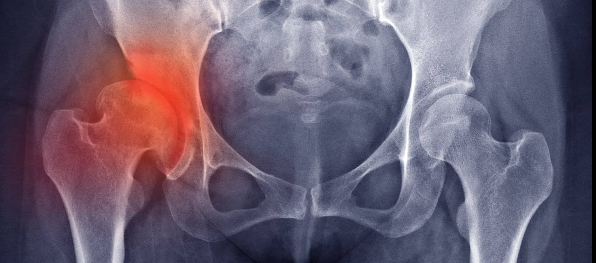 Comment diagnostiquer une dysplasie de la hanche ? | Dr Paillard | Paris