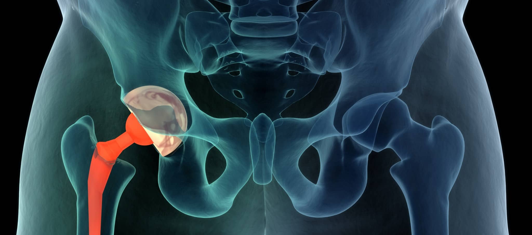 Pourquoi ma prothèse de hanche me fait mal ? | Dr Paillard | Paris