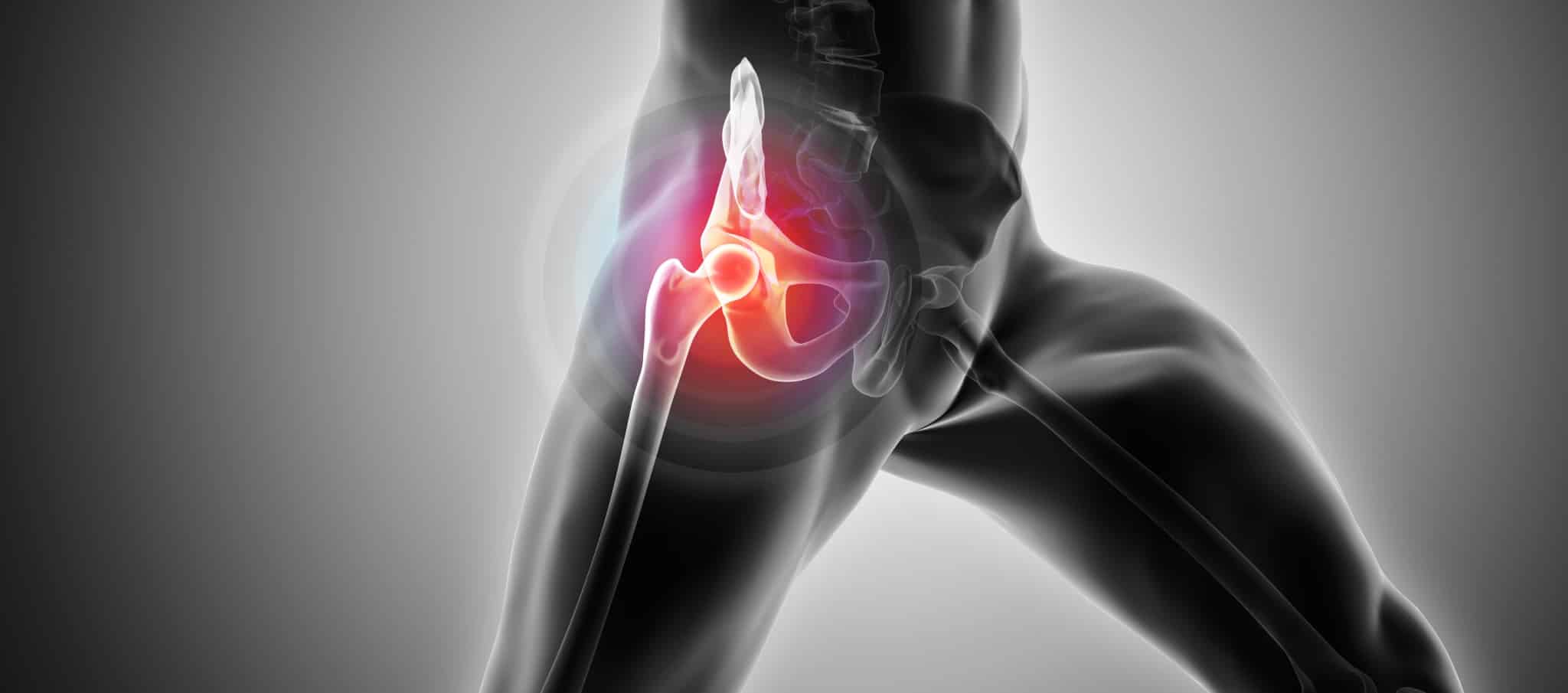 Rétablissement pose prothèse hanche | Dr Paillard | Paris