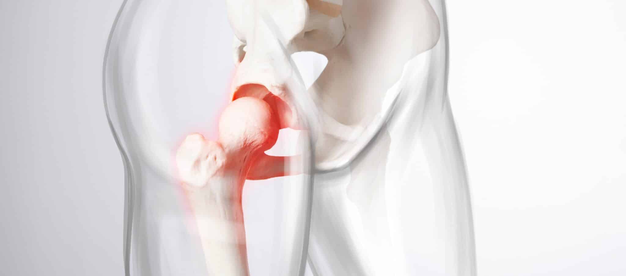 Comment prévenir une nécrose de la hanche ? | Dr Paillard | Paris