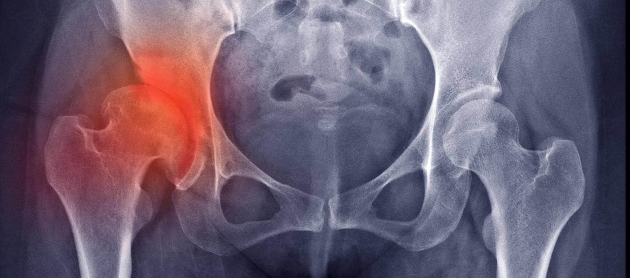 Soulager une arthrose de la hanche