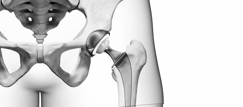 Quelle est la durée de vie d'une prothèse de hanche ? | Dr Paillard | Paris