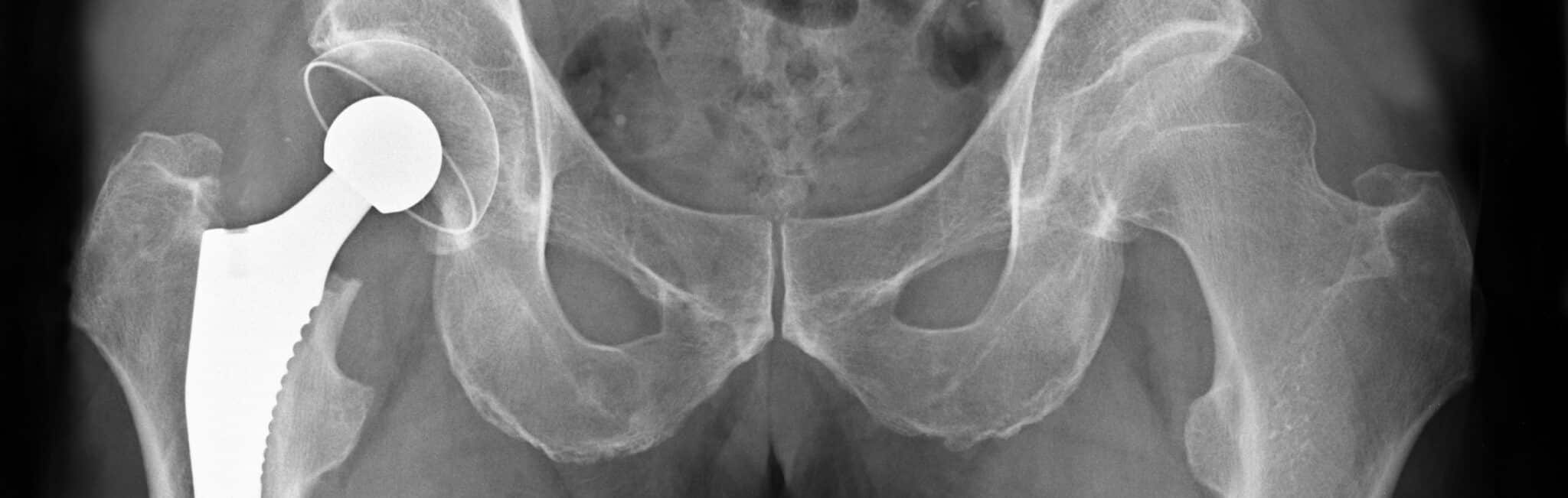 Quels sont les symptômes d’un descellement de prothèse de hanche ? | Dr Paillard | Paris