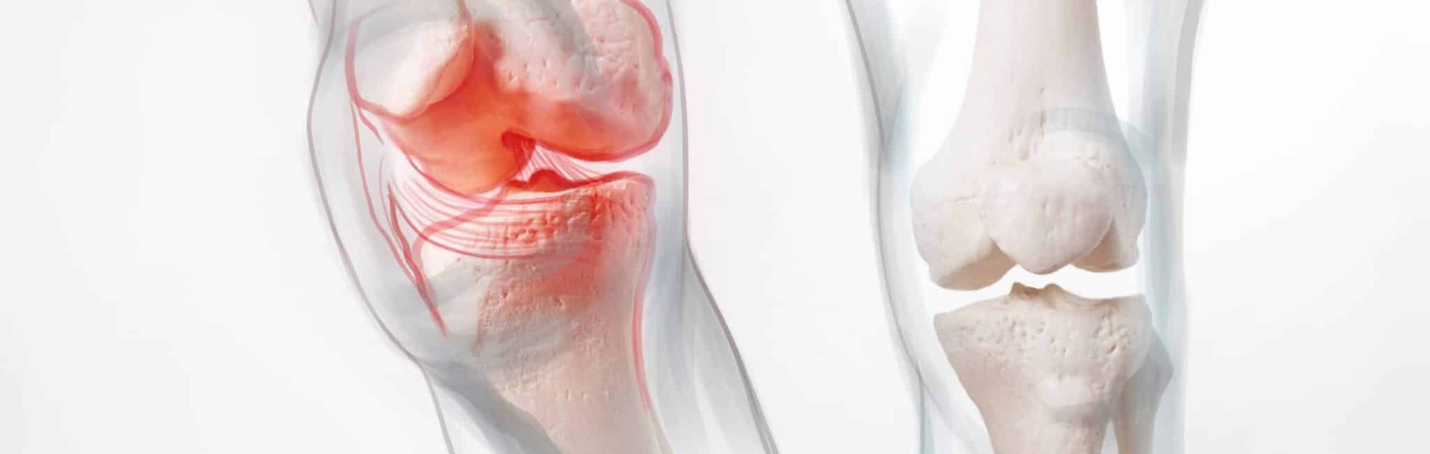 Comment savoir si j'ai de l'arthrose au genou ? | Dr Paillard | Paris