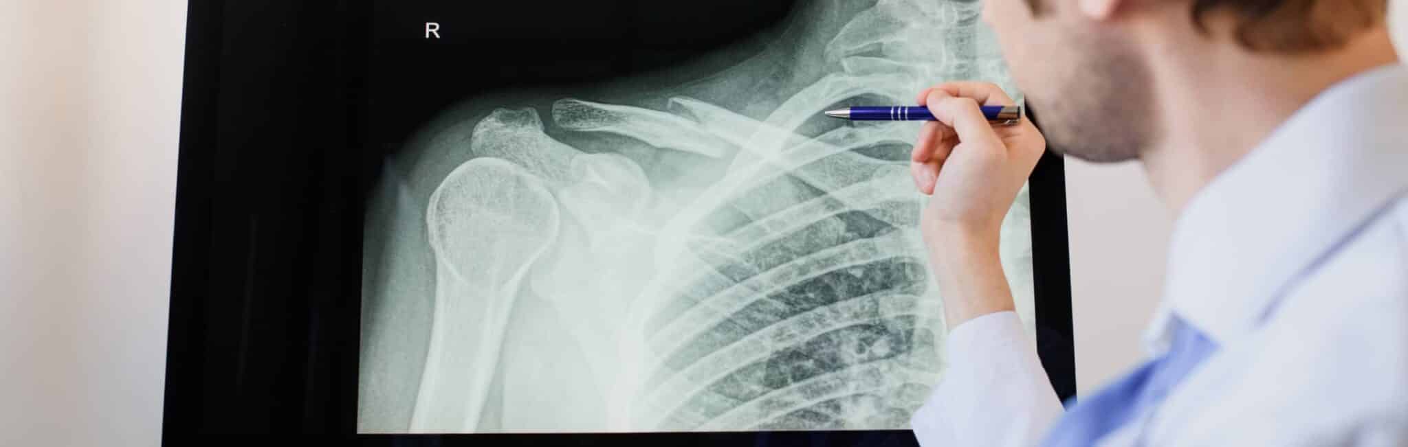 Fracture de l'omoplate durant le sport comment réagir ? Dr Paillard